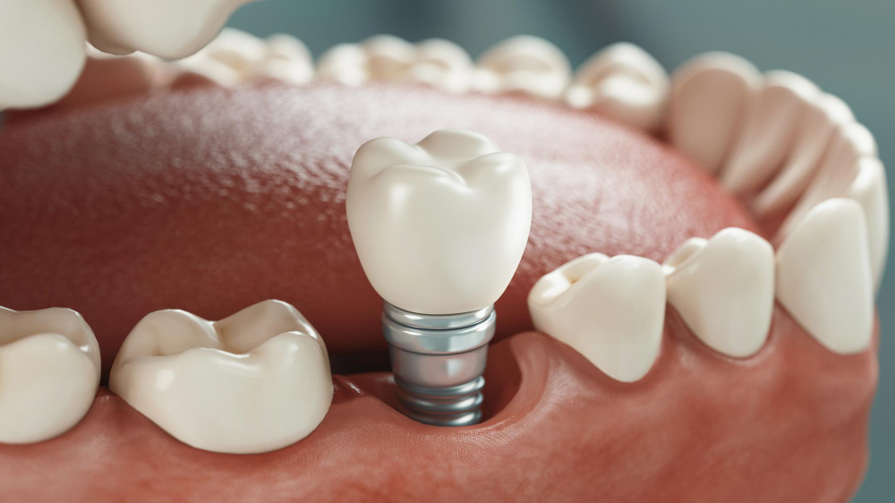 Dental Implants in Memphis
