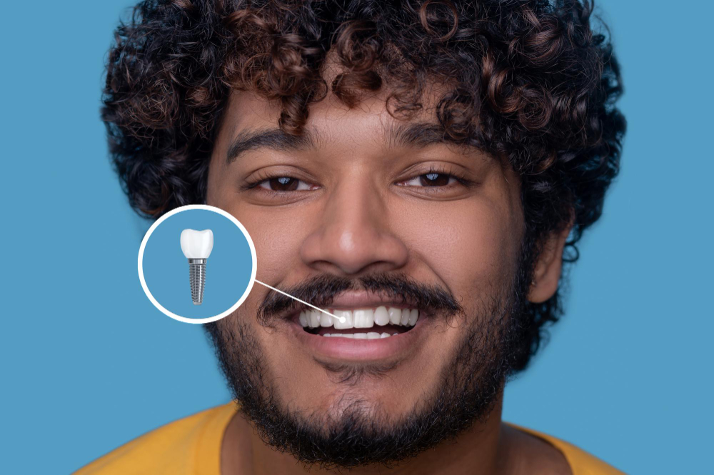 Implant Restoration in Memphis